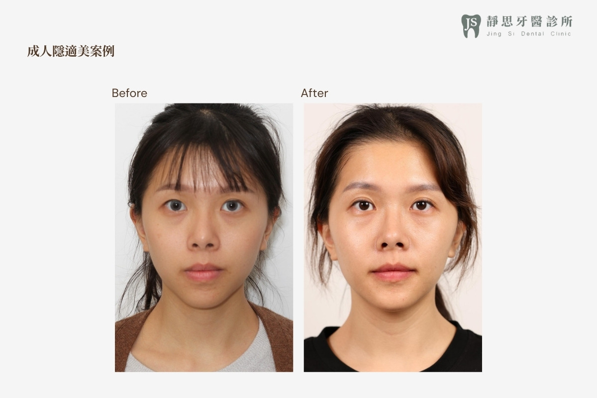 成人矯正CASE_23 矯正前後對照（正面）