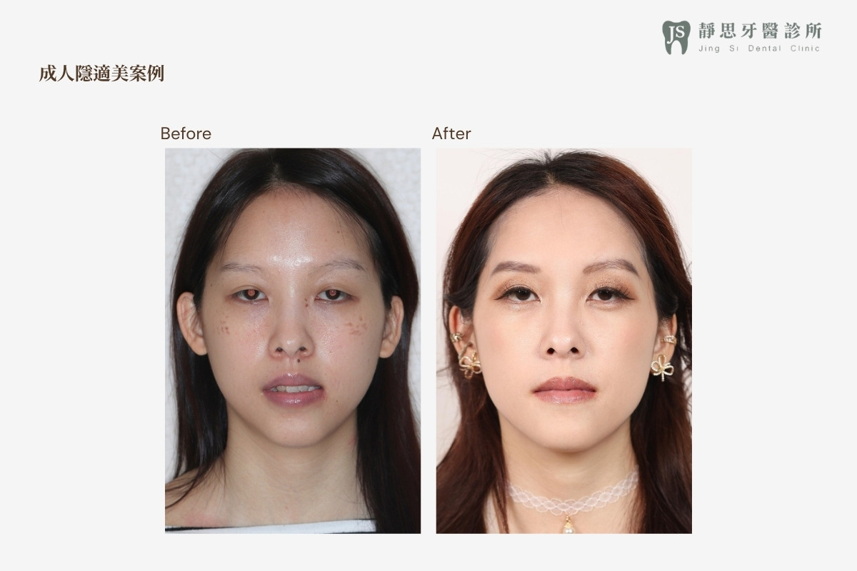 成人矯正CASE_24 矯正前後對照（正面）