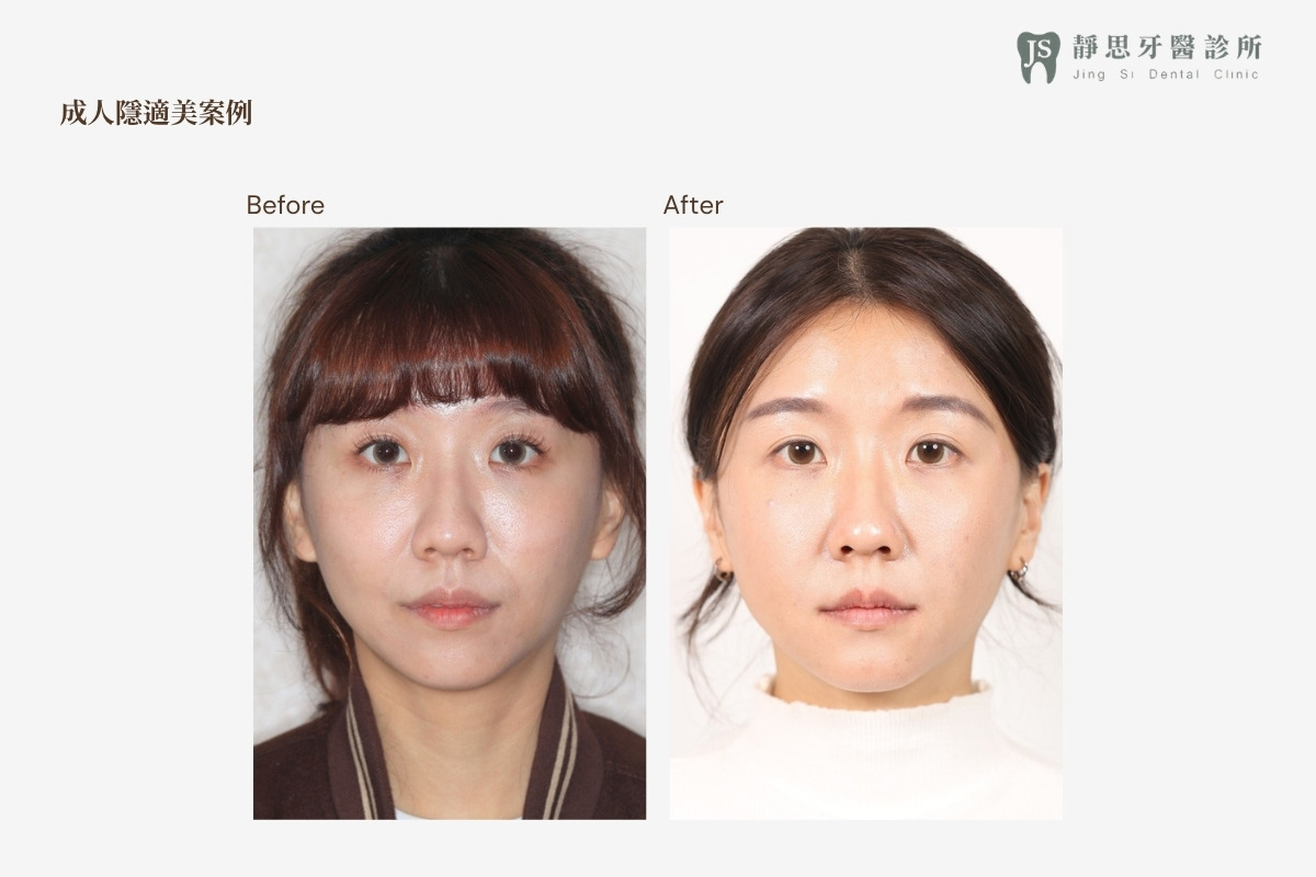 成人矯正CASE_26 矯正前後對照（正面）