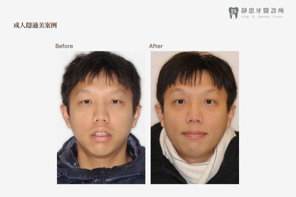 成人矯正CASE_27 矯正前後對照（正面）