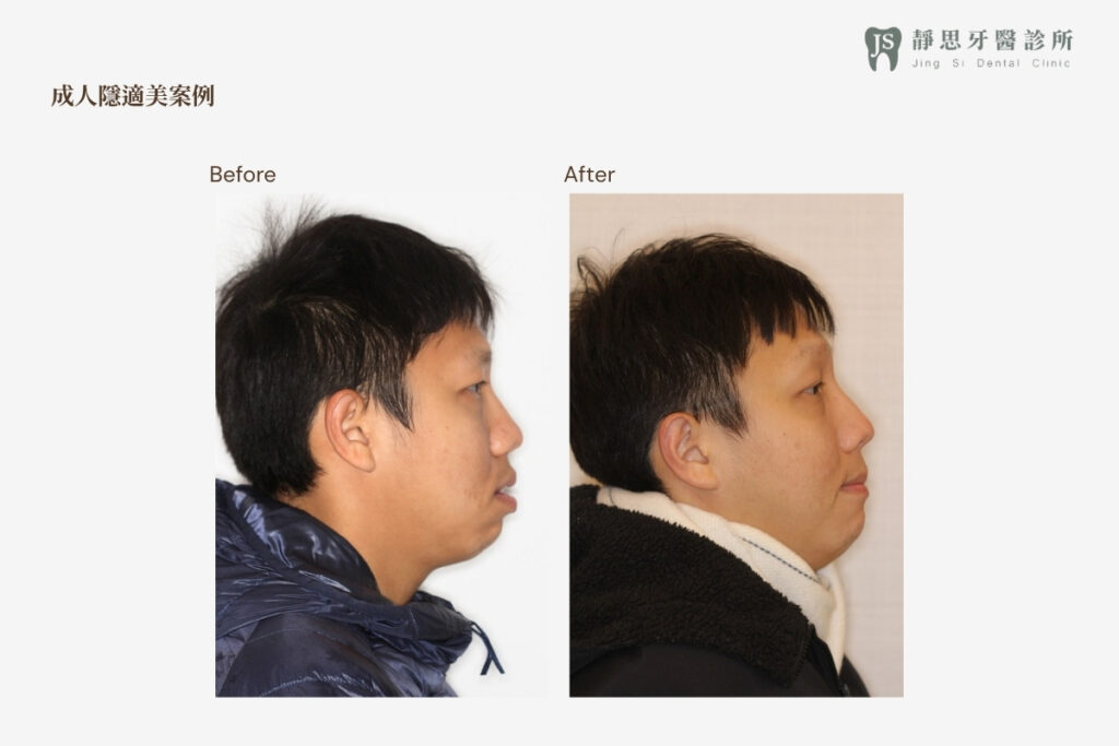 成人矯正CASE_27 矯正前後對照（側面）